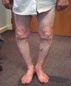 04_varus_knees.jpg
