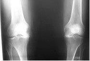 05_varus_knees.jpg