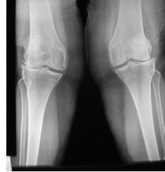 07_valgus_knees.jpg
