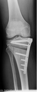 Opening wedge osteotomy