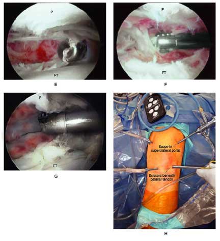debridement of the knee