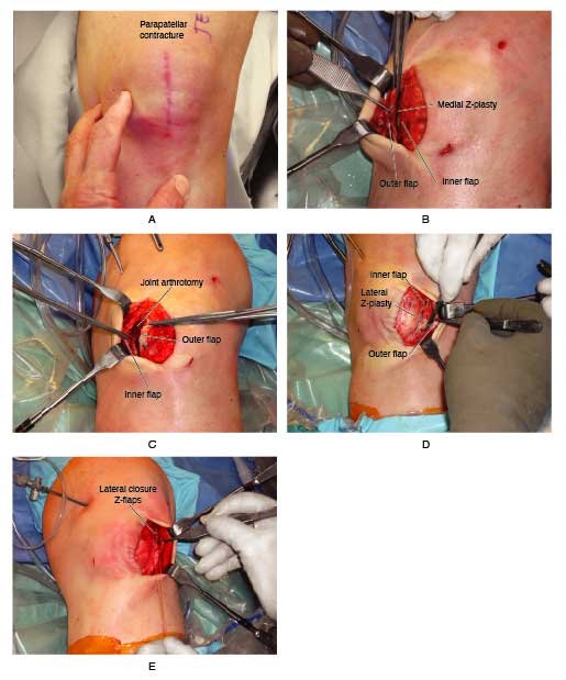 z-plasty of knee