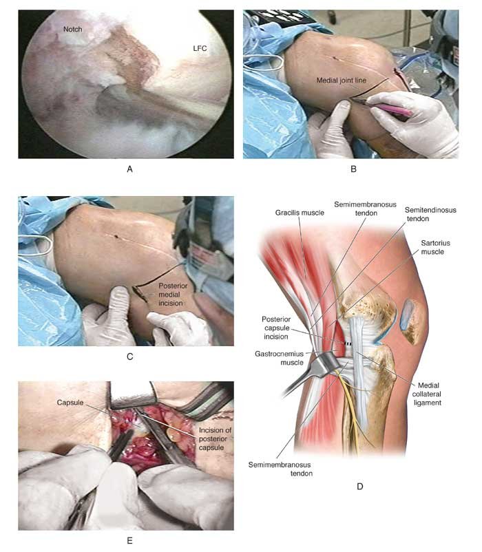 lysis of adhesions of the knee