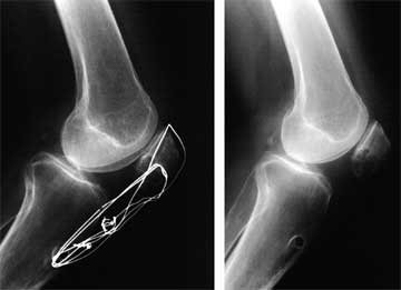 z-plasty x-rays