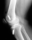 ACL with tunnel too anterior
