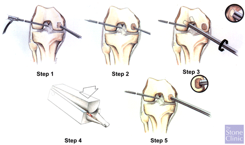 articular paste grafting