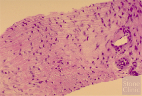 biopsy of regenerated meniscus