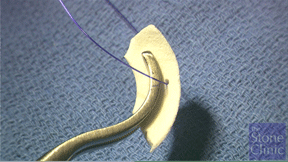 collagen meniscus scaffold