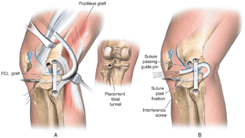 PMTL graft replacement