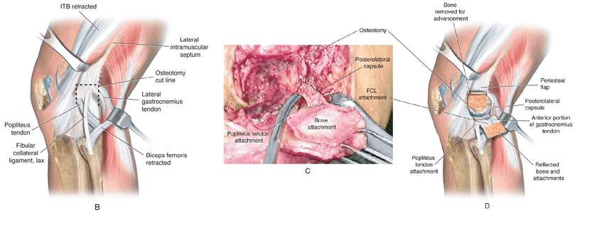 proximal advancement