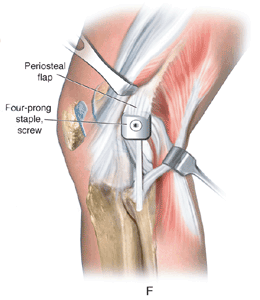graft fixation