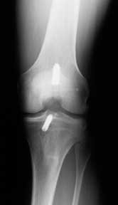 ACL graft too vertical