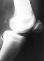 normal patella