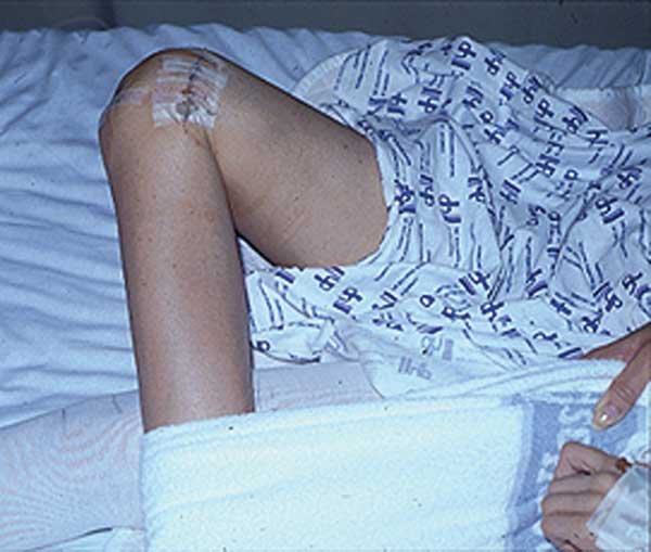 flexion overpressure