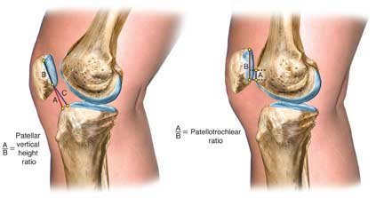 measuring the patella
