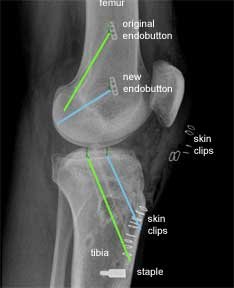 ACL revision
