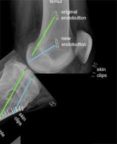 ACL revision