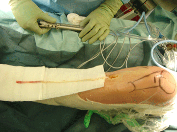 MPFL reconstruction