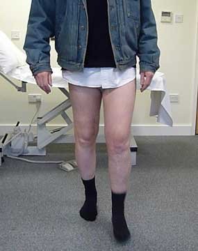 twelve weeks after osteotomy