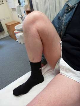twelve weeks after osteotomy