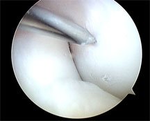 microdrilling of ocd