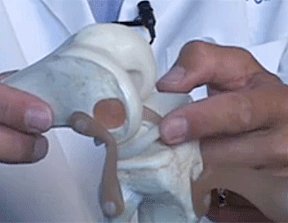 Pointing_to_meniscal_cartil.png