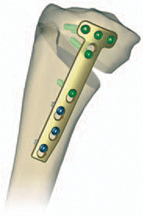 high tibial osteotomy