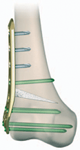 distal femoral osteotomy