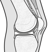anterior interval arthrofibrosis