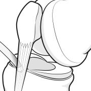 anterior interval release