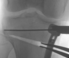 Fluoroscopy during osteotomy