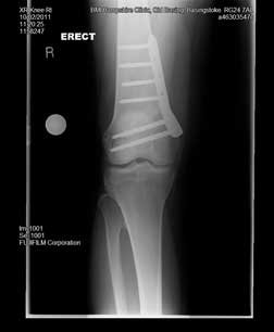 varus knees