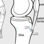 juvenile traction apophysitis