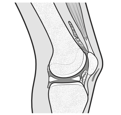 adhesions behind the quads muscles