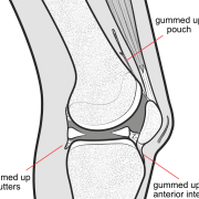 arthrofibrosis of the knee