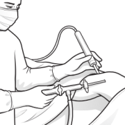 arthroscopic surgery