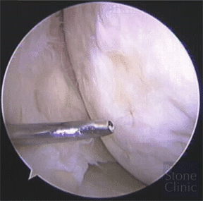 paste grafted area prior to biopsy