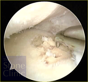 tibial plateau after microfracture