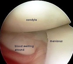 bleeding during arthroscopy