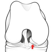 bucket-handle lesion locking joint