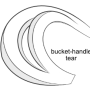 bucket-handle tear of the meniscus