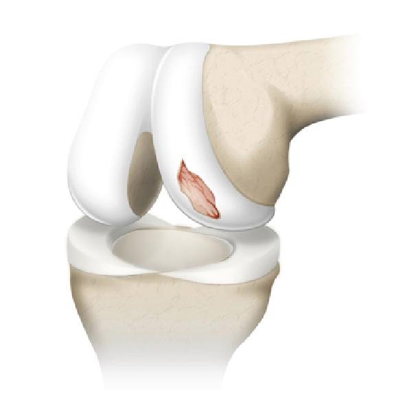 cartilage defect on femur