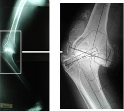 arthritis