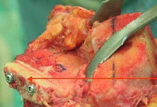 building up the tibial plateau