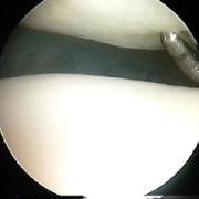 Outerbridge Grade I - Chondromalacia or softening of the joint cartilage
