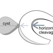 meniscal cyst originating from a horizontal cleavage tear of the meniscus
