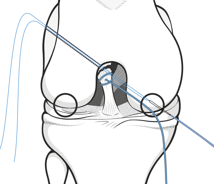 cruciate repair procedure