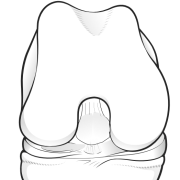 cyclops lesion after ACL reconstruction