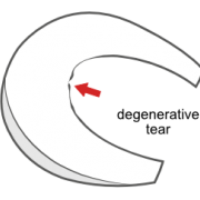 degenerative tear of the meniscus