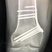 distal femoral osteotomy for osteochondral defect